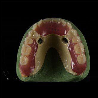 תותבת מסגרת הצצה