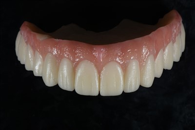 כתר זמני שרף אקרילי